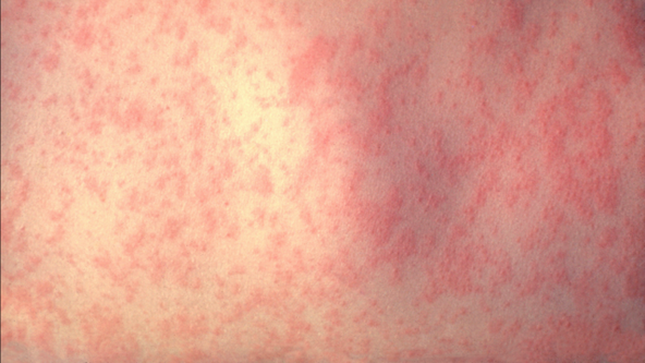 Texas Measles Outbreak: State only reports 1 new case in latest update