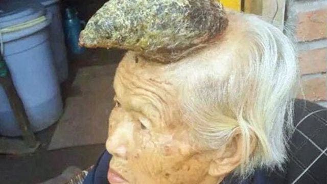'Unicorn woman' appeals for help as rare condition causes horn-like growth