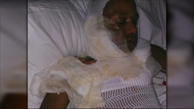 Boy set on fire by bully