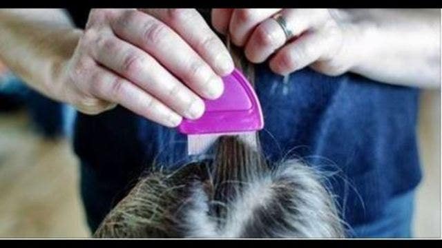 'Super lice' outbreak hits 25 states, including Texas