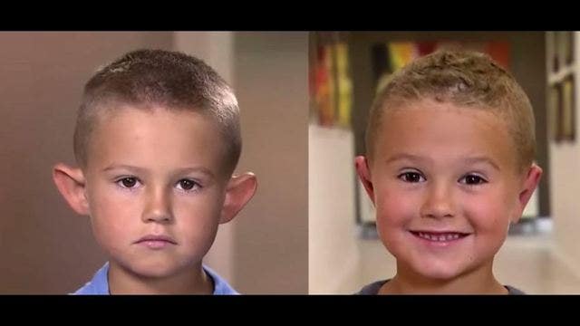 Heartbreaking reason why a 6-year-old boy got plastic surgery