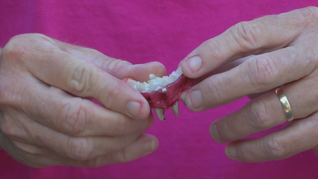 Woman claims costume vampire fangs got stuck on her own teeth