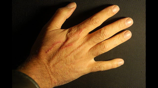 Farmer cut off his right hand in failed ploy for insurance money