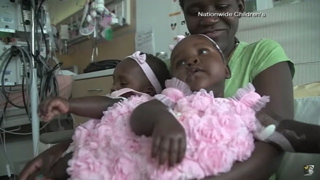Conjoined twin girls from Uganda separated in Ohio surgery