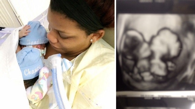 Conjoined Twins Pass Away in Augusta