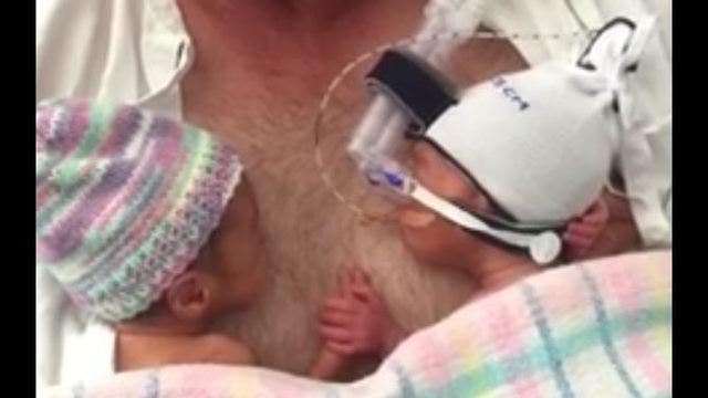 Premature twins hold hands on dad in video watched by millions
