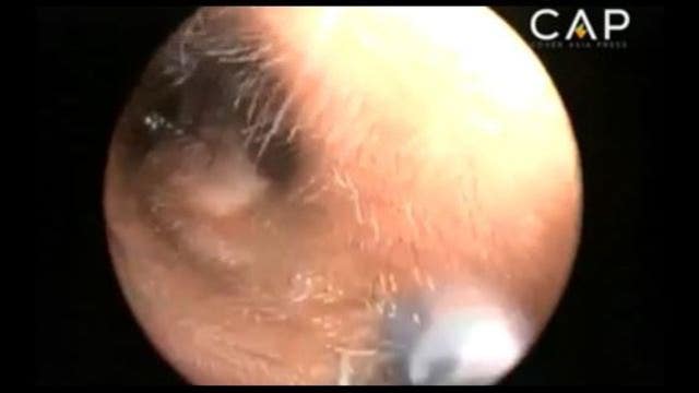 Colony of ants found living in 12-year-old girl's ear