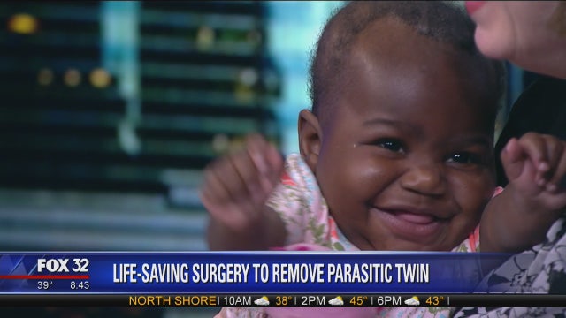 Baby who underwent surgery to remove parasitic twin doing great weeks later