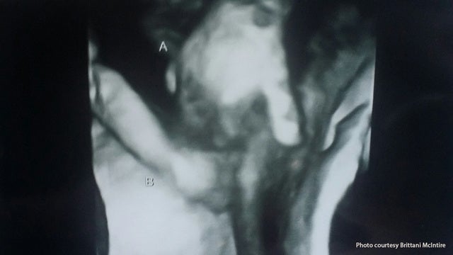 Touching sonogram image shows dying twin holding sister's hand