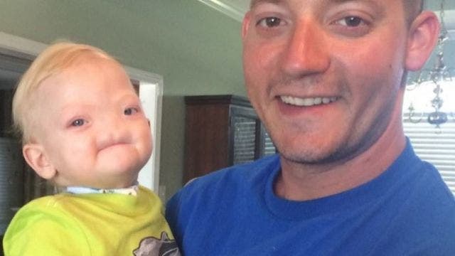 'Miracle baby' born without a nose dies at age 2