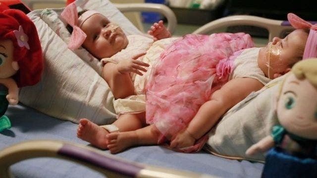 Surgery separates infant conjoined twins in Texas