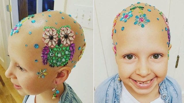 Little girl with alopecia celebrates 'Crazy Hair Day' in a beautiful way