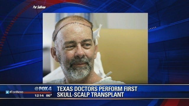 Texas doctors do first skull and scalp transplant