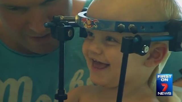 Australian Toddler Recovering After Head Reattached in 'Miracle Surgery'