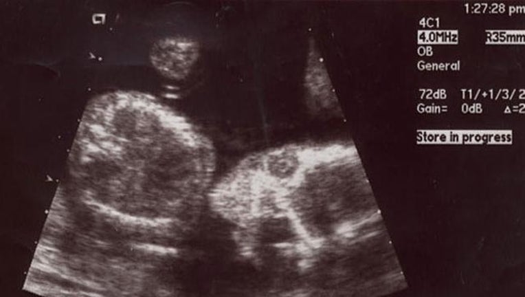 Sonogram, abortion