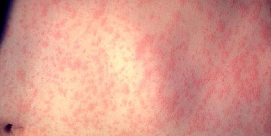 Texas measles outbreak 2025: State identifies 20 new cases, state total climbs to 561