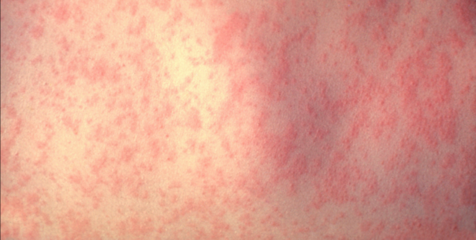 Texas measles outbreak 2025: First death reported