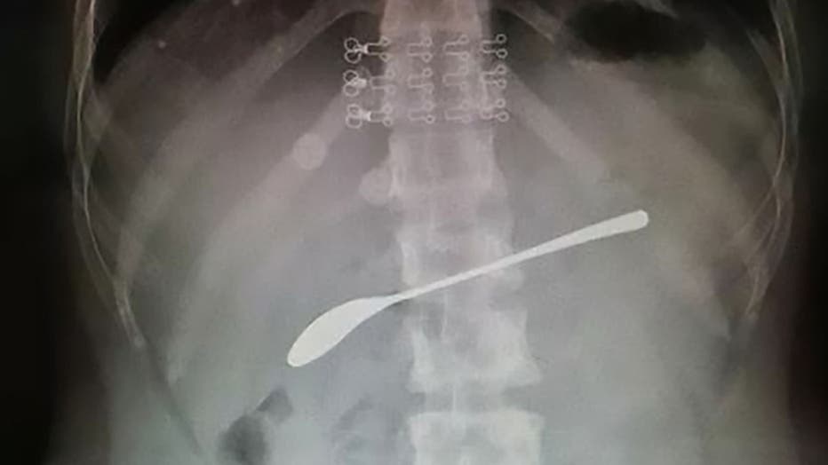 This X-ray shows a 6-inch steel spoon resting inside the stomach of a young woman who drunkenly swallowed it the night before and forgot about it until her stomach began hurting the next day.
