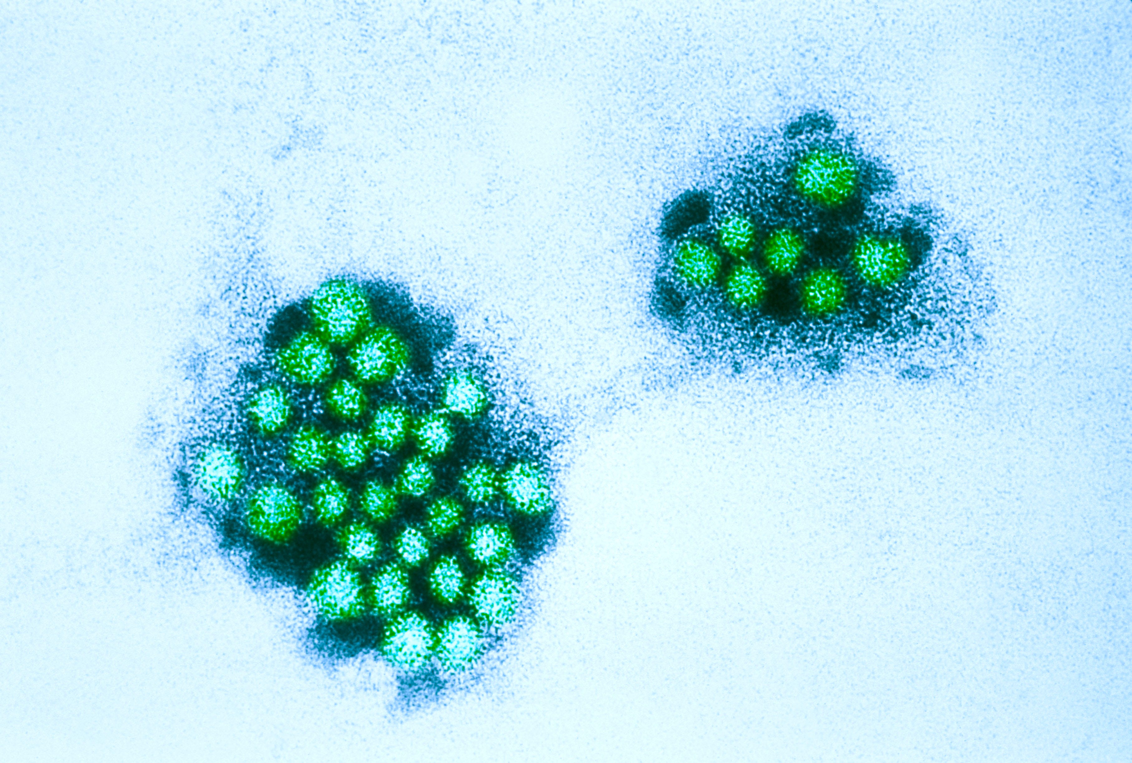 Norovirus outbreak forces North Texas middle school to shut down
