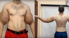 Russian 'Popeye' has 3 pounds of 'dead' muscle removed after DIY bodybuilding injections