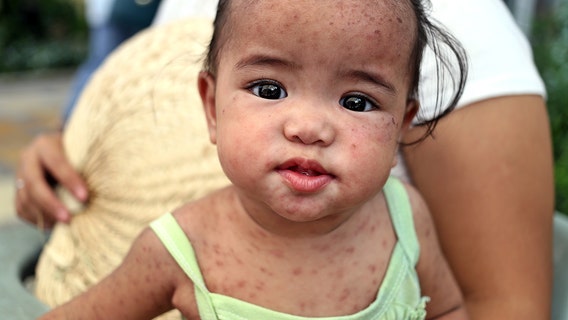 Texas measles outbreak: Six new cases reported in latest update