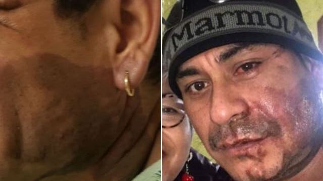 Family says suspect in acid attack is veteran, suffered PTSD