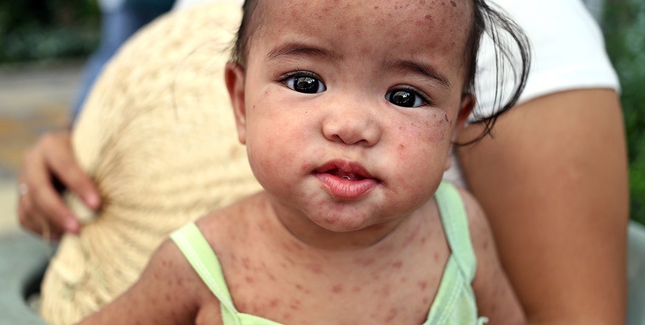 Texas measles outbreak 2025: Cases surpass 600