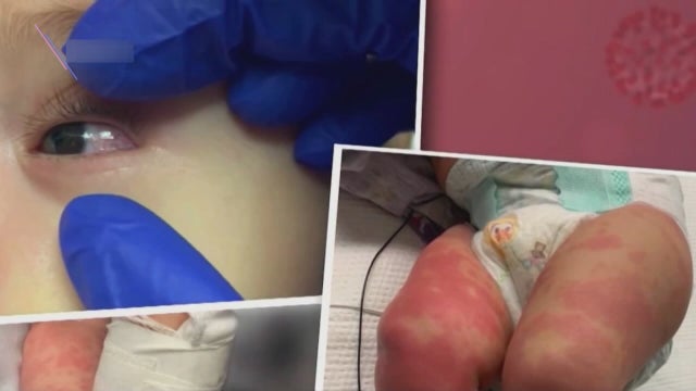 Cook Children’s Fort Worth seeing mystery illness in children possibly linked to COVID-19