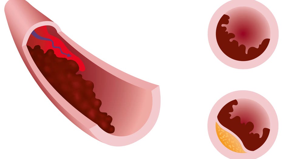 blood-clot-illustration-GETTY.jpg