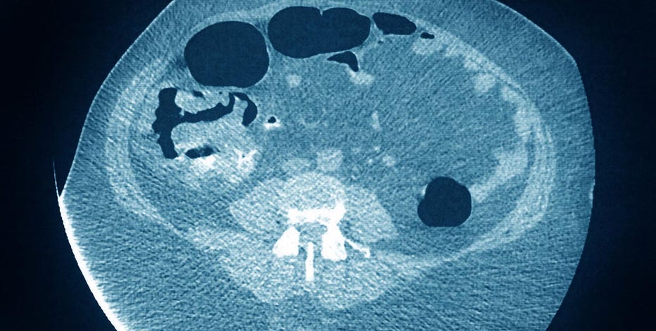 Colon cancer screenings should start at age 45, not 50, US health panel says