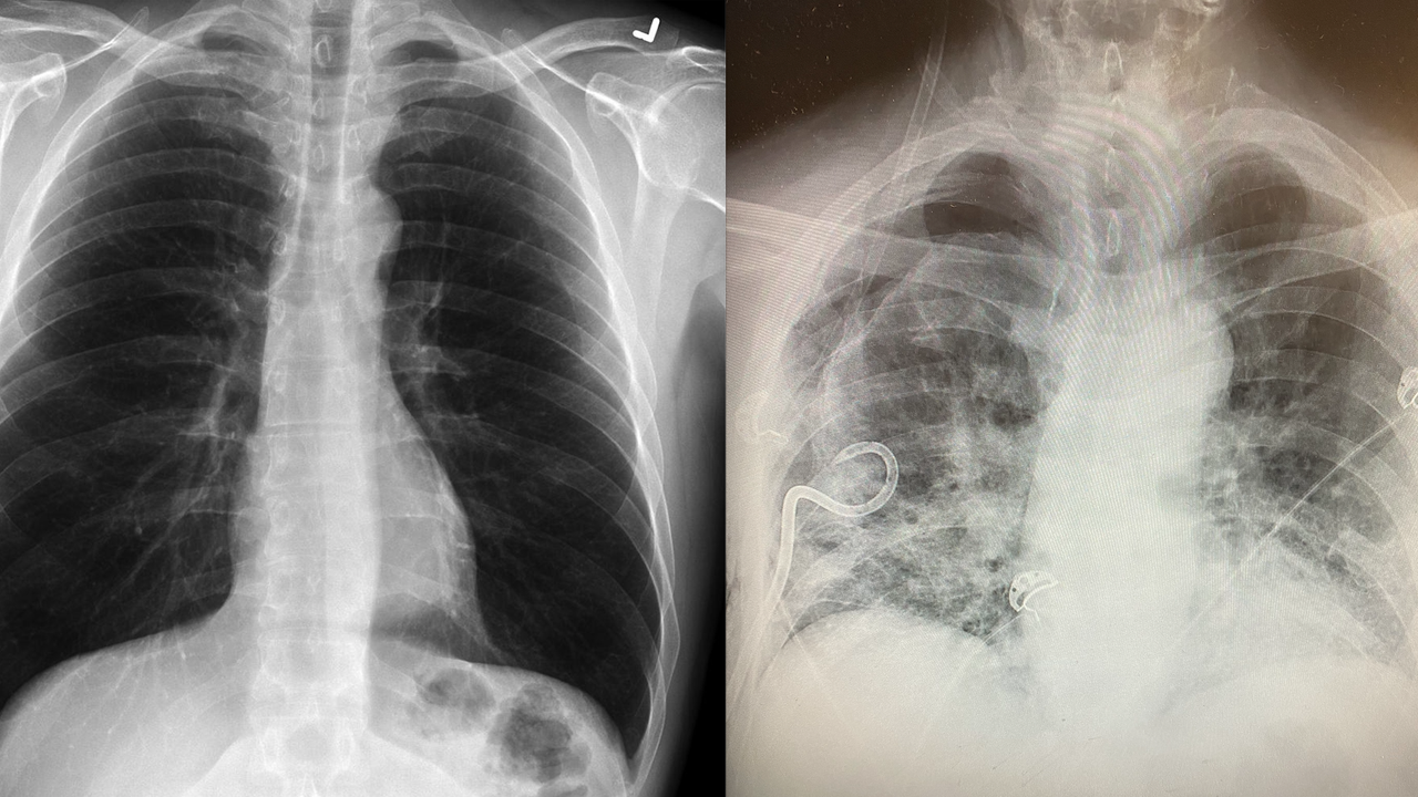 Поражение легких при ковиде. Поражение легких от кальяна. Codid 19 lungs pattern CT. Scars from lung Surgery.