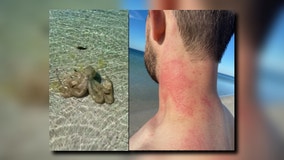 Man finds ‘the angriest octopus’ on Australian beach, later attacked while swimming