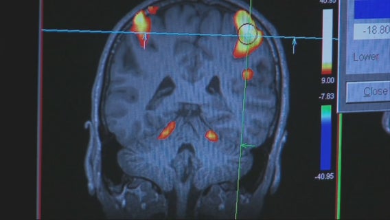 Dallas family hopeful newly-approved Alzheimer’s drug will eventually lead to a cure in the future