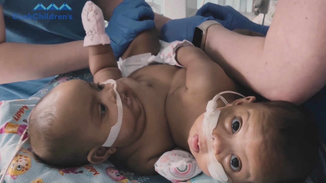 Conjoined twins separated at Cook Children's Medical Center | FOX
