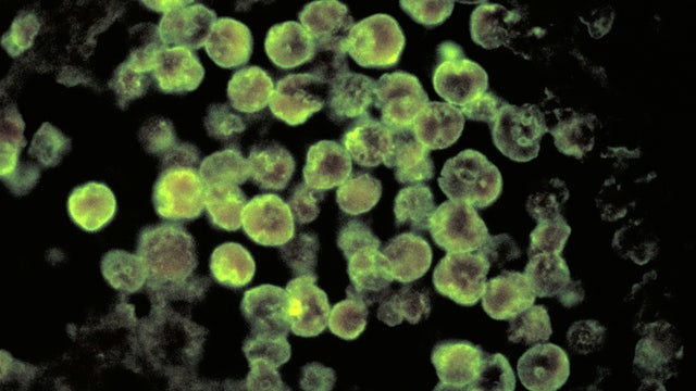 Woman killed by brain-eating amoeba after cleaning sinuses with water in Texas: CDC