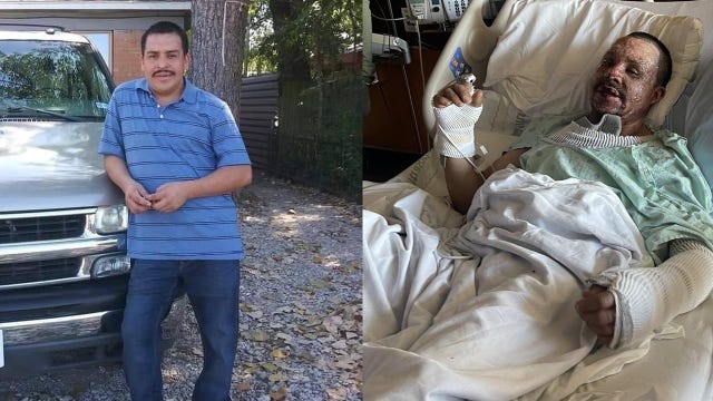 Dallas home explosion leaves man badly burned, cause under investigation