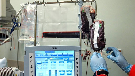 Dallas hospital among those approved to provide new gene therapy for sickle cell disease