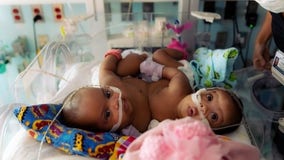 Conjoined twins separated at Cook Children’s now walking and talking