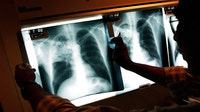 Irving ISD high school investigated for possible tuberculosis exposure