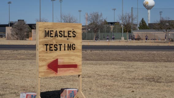 Texas measles outbreak: No new cases in connection to West Texas outbreak