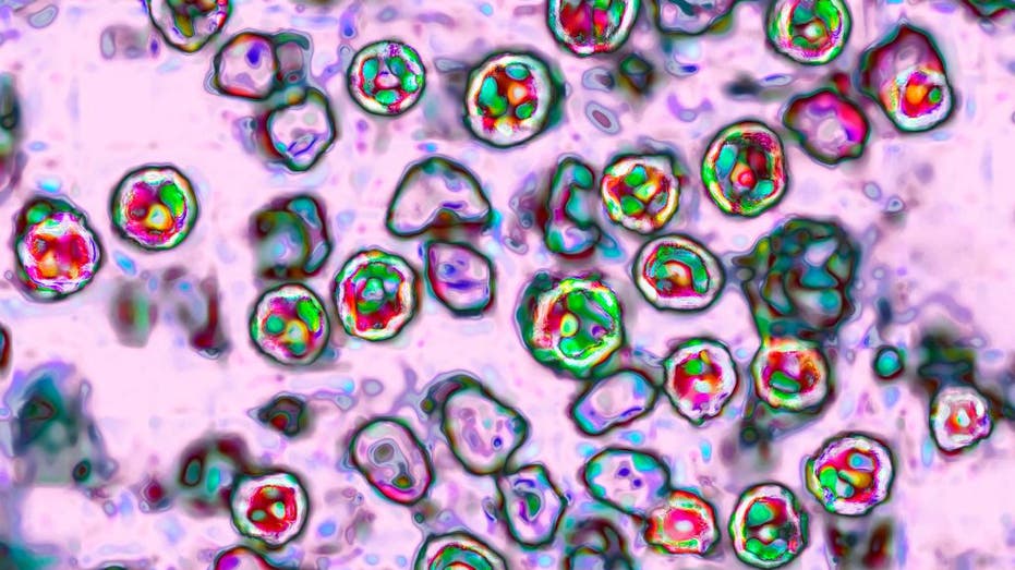 Dallas County confirms measles case with 3 locations for exposure — FOX 4 Dallas