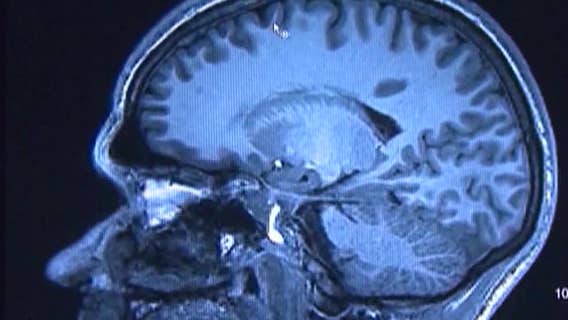 New Alzheimer's report shows an increase in cases, desire for early detection