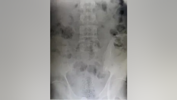Texas Border Patrol finds 1/3lb fentanyl hidden in rectum of border crosser