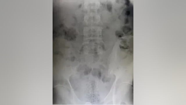 Texas Border Patrol finds 1/3lb fentanyl hidden in rectum of border crosser