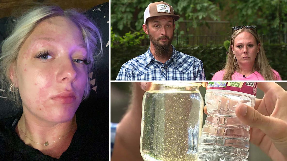 Trinidad family says daughter suffered chemical burn after showering with city's water
