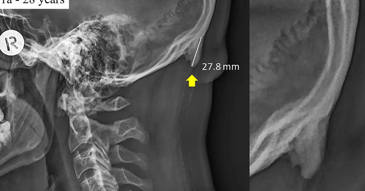 Larger bone spike at back of head in young adults possibly due to
