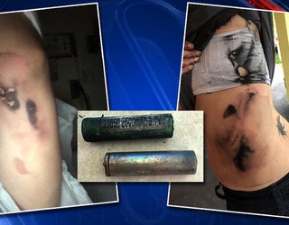 battery injury_1530568161117.jpg-401385.jpg