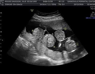 quadruplet ultrasound picture