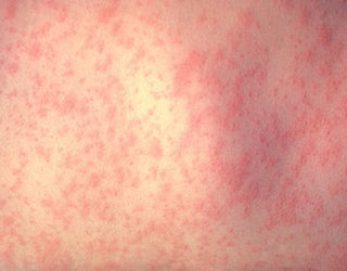 Measles Infection (GETTY)-408200
