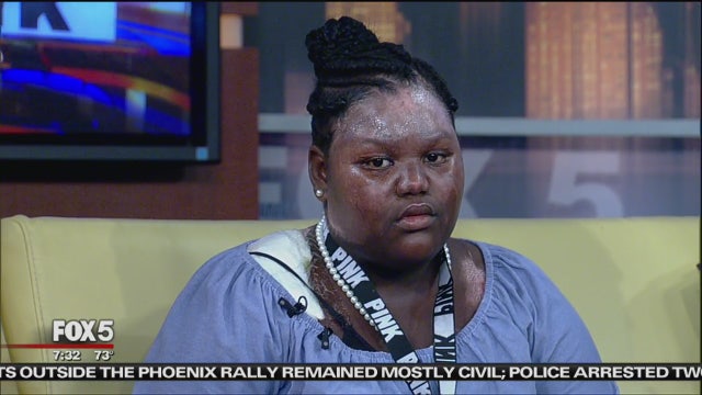 Girl doused with boiling hot water recovering